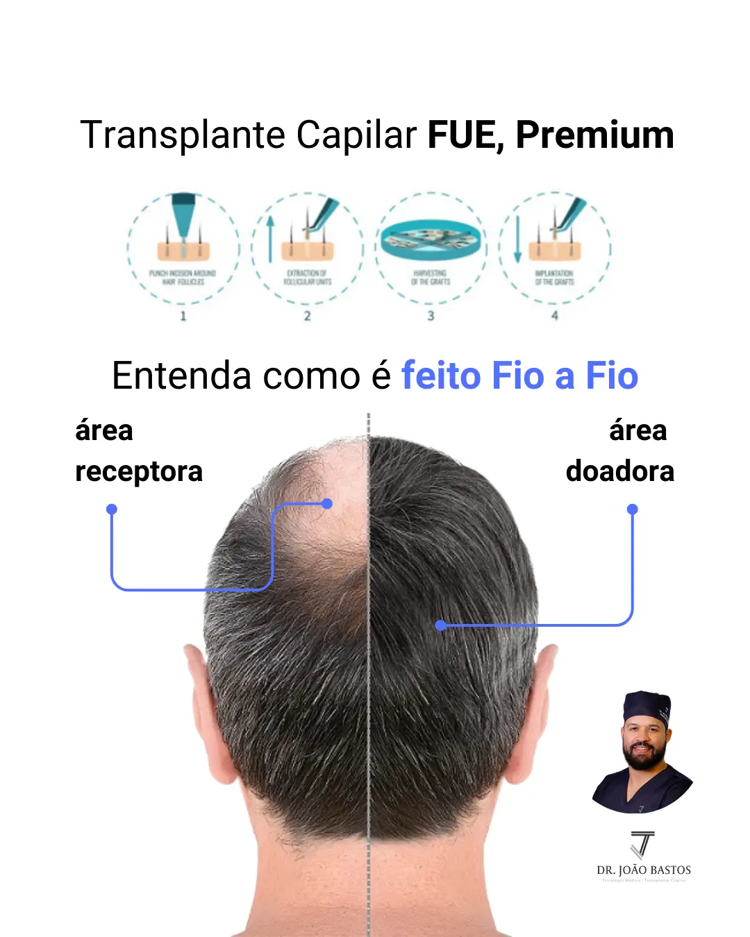 Transplante Capilar fue antes e depois Dr João Bastos